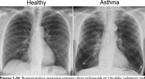 asthma on xray